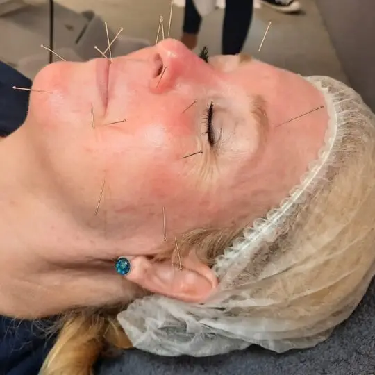 Cosmetische acupunctuur